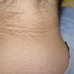 acanthosis-nigricans-photos-620×350