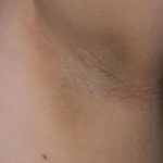 acanthosis-nigricans4-830×0